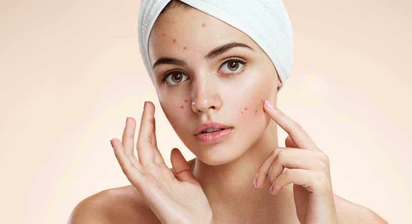 Acne (PIMPLE) Treatment