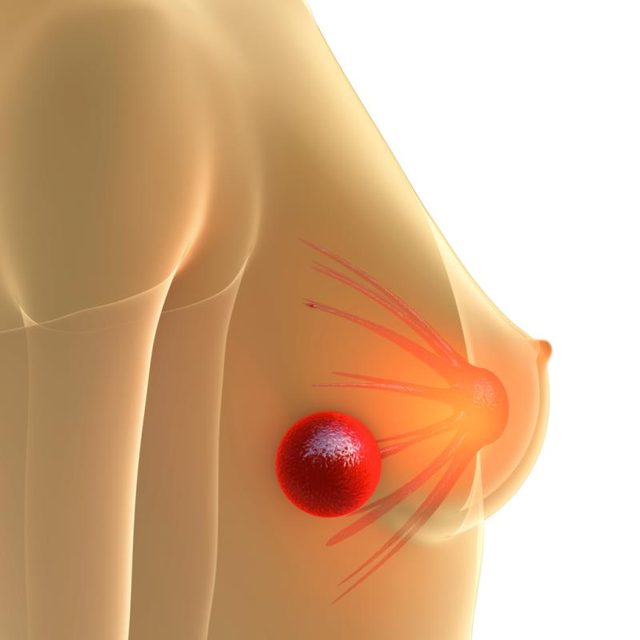 BREAST LUMP- BREAST CANCER SURGERY in Aligarh -Skin Hair Expert
